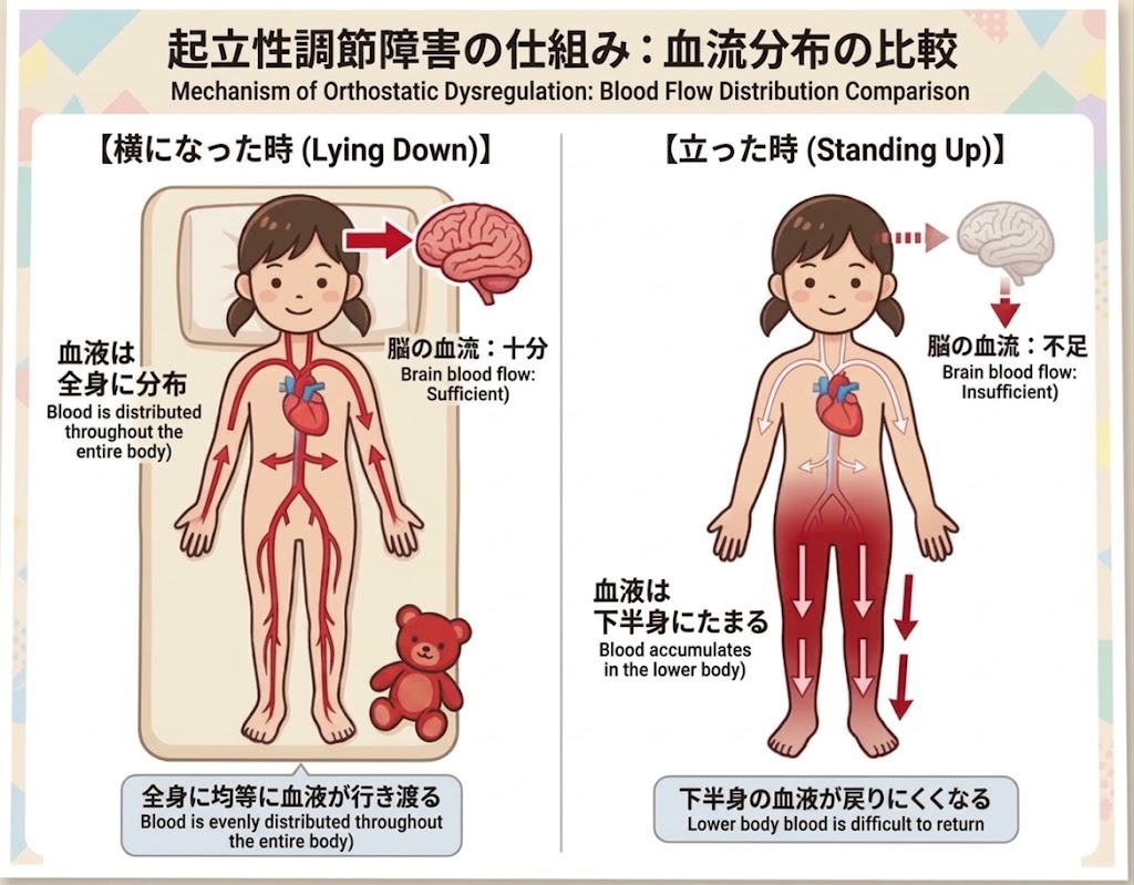 横になっているときは血液が全身にいきわたるが、立ち上がると血液が下半身にたまり脳への血流が一時的に不足する、起立性調節障害の仕組みを示した図